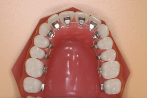 歯６