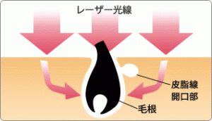 脱毛のメカニズム